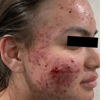 After treatment 1 — right profile