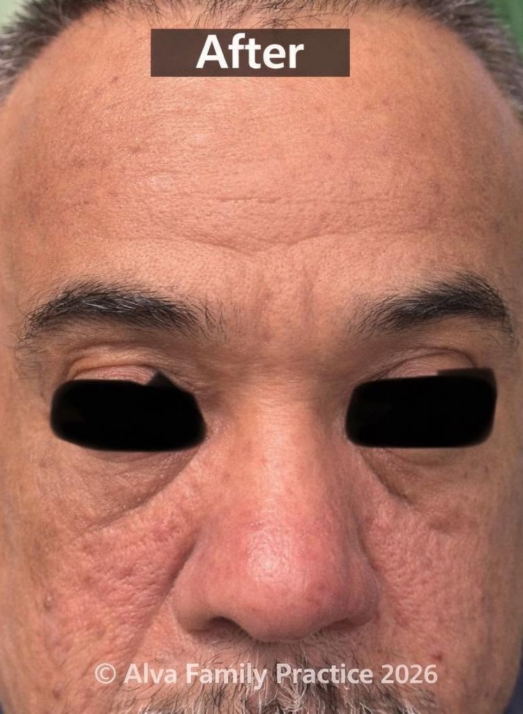 One week after a single Morpheus8 treatment — smoother forehead, reduced eye bags